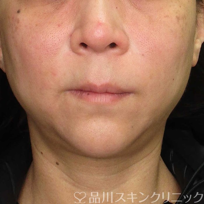 症例NO.70424のAFTER写真