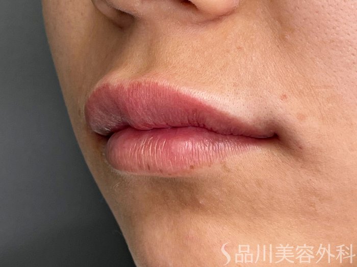 症例NO.62921のAFTER写真