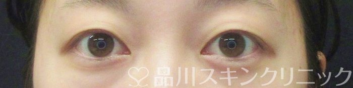 症例NO.64896のBEFORE写真