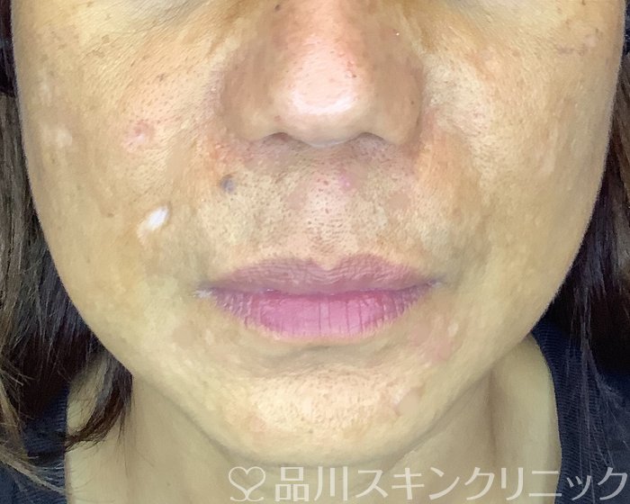 症例NO.69951のBEFORE写真