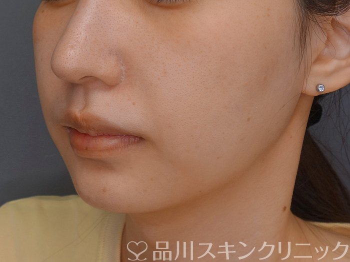 症例NO.73786のBEFORE写真