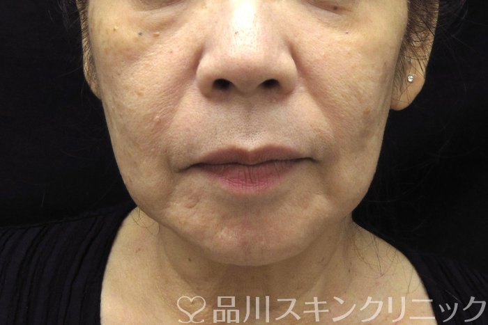 症例NO.74387のBEFORE写真