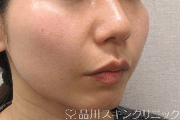 症例NO.69277のAFTER写真