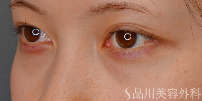 症例NO.73529のBEFORE写真