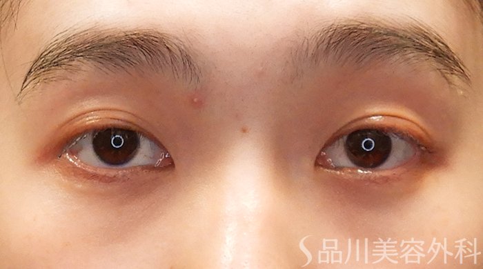 症例NO.69304のAFTER写真