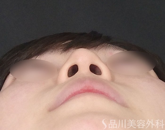 症例NO.65274のBEFORE写真
