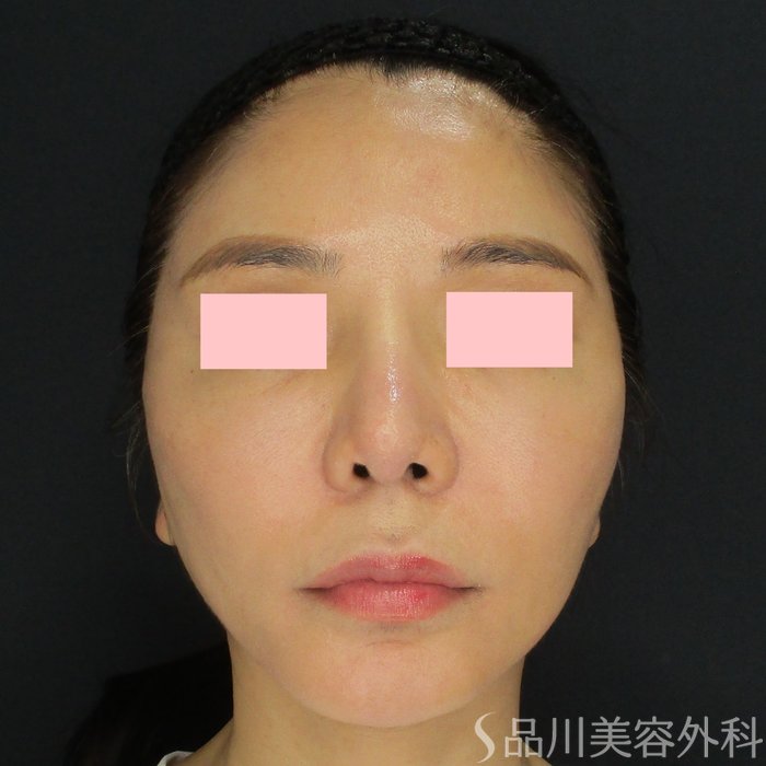 症例NO.72988のAFTER写真