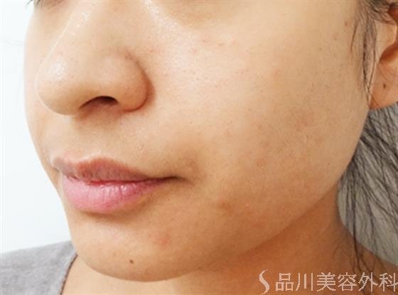 症例NO.33420のBEFORE写真