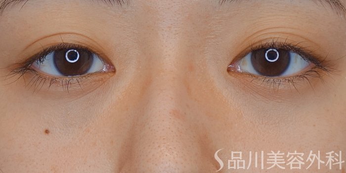 症例NO.71602のAFTER写真