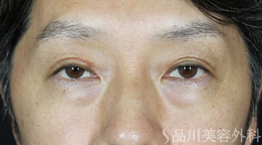 症例NO.62021のBEFORE写真