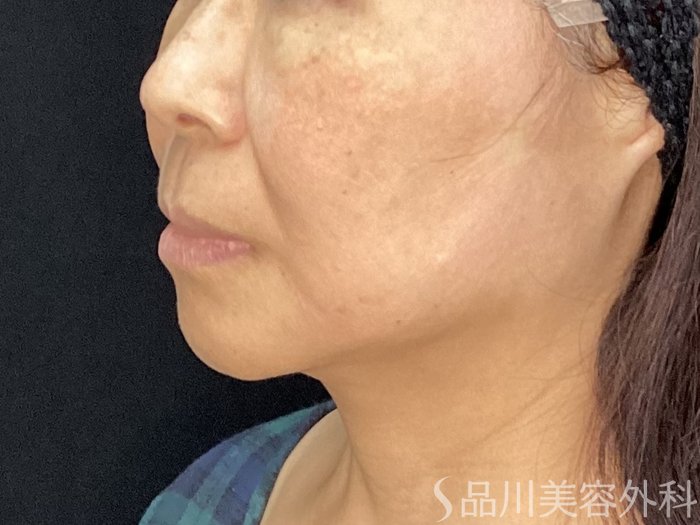 症例NO.71984のAFTER写真