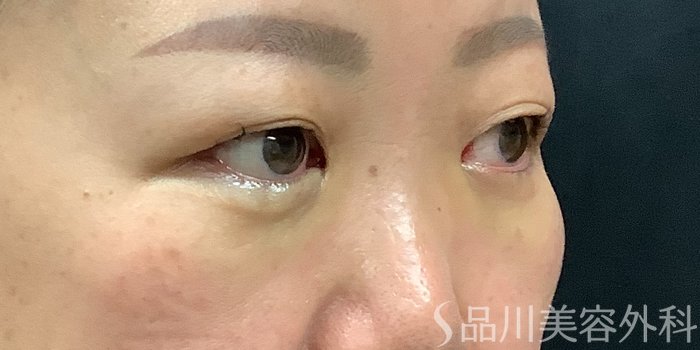 症例NO.71236のAFTER写真
