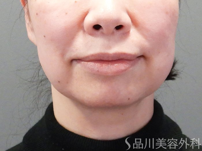 症例NO.73373のBEFORE写真