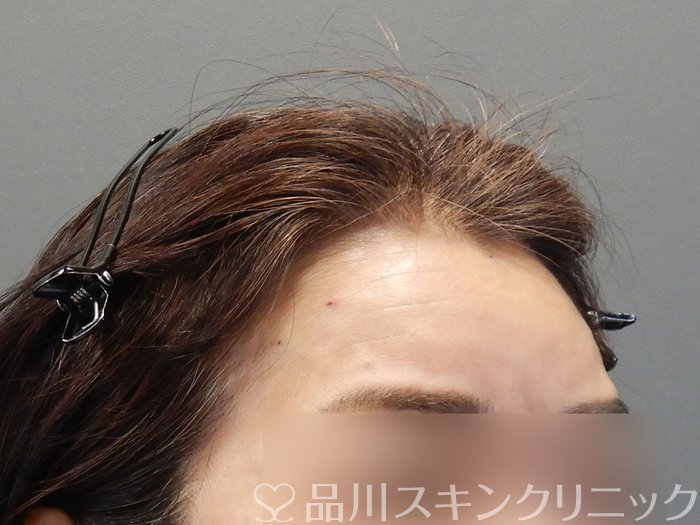 症例NO.72652のAFTER写真