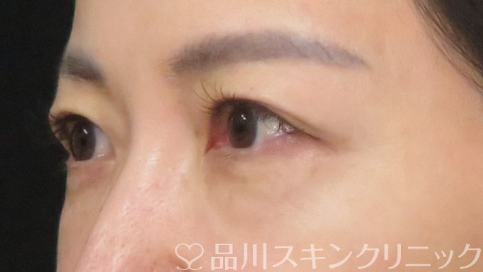 症例NO.70698のBEFORE写真