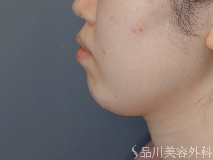 症例NO.71362のBEFORE写真