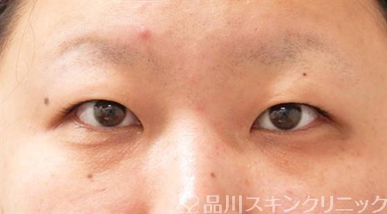 症例NO.54006のBEFORE写真