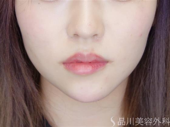 症例NO.51310のAFTER写真