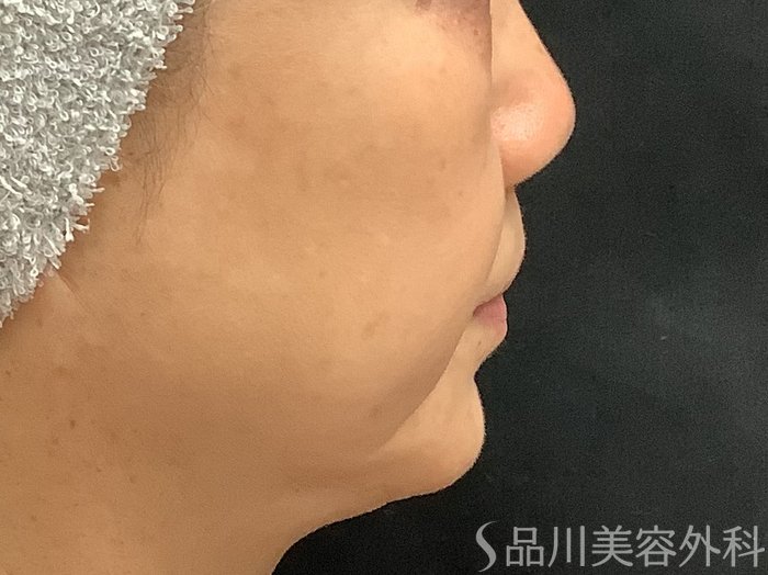 症例NO.67772のBEFORE写真