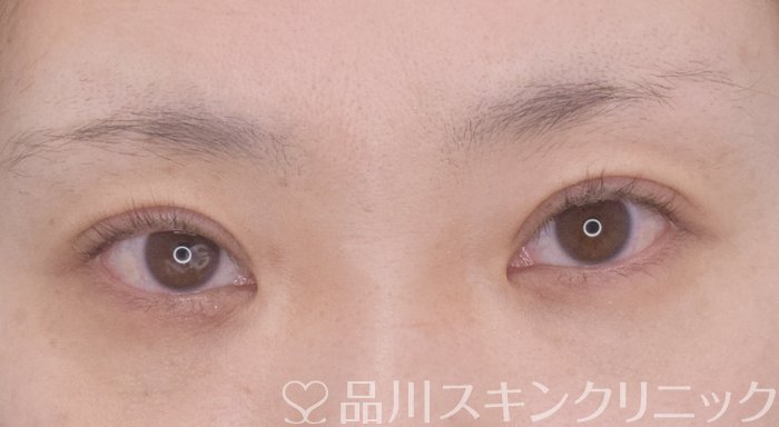 症例NO.64812のAFTER写真