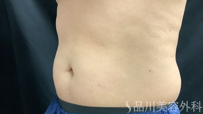 症例NO.75386のBEFORE写真