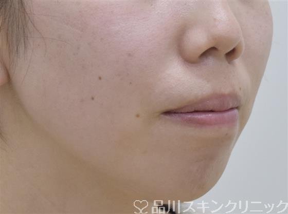 症例NO.53197のBEFORE写真