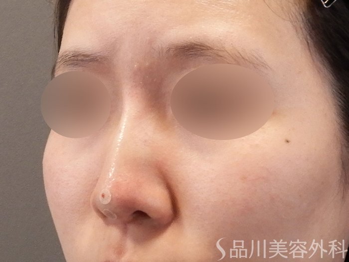 症例NO.65232のAFTER写真