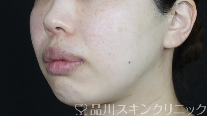 症例NO.71269のBEFORE写真