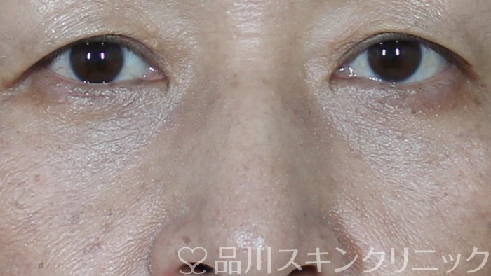 症例NO.71730のAFTER写真