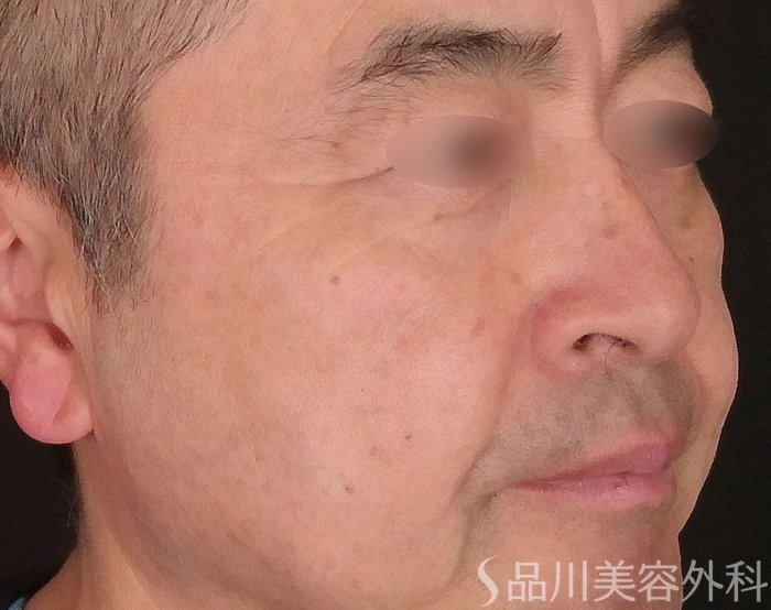 症例NO.70070のAFTER写真