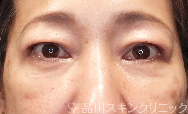 症例NO.68166のAFTER写真