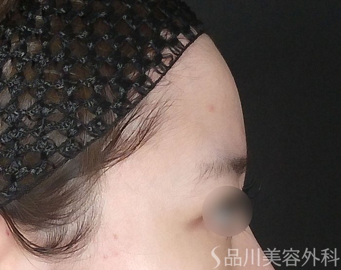 症例NO.70172のBEFORE写真
