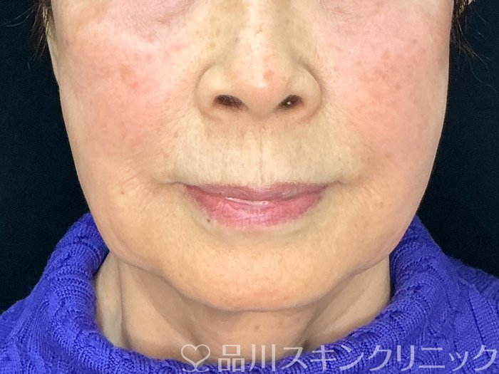 症例NO.73212のBEFORE写真