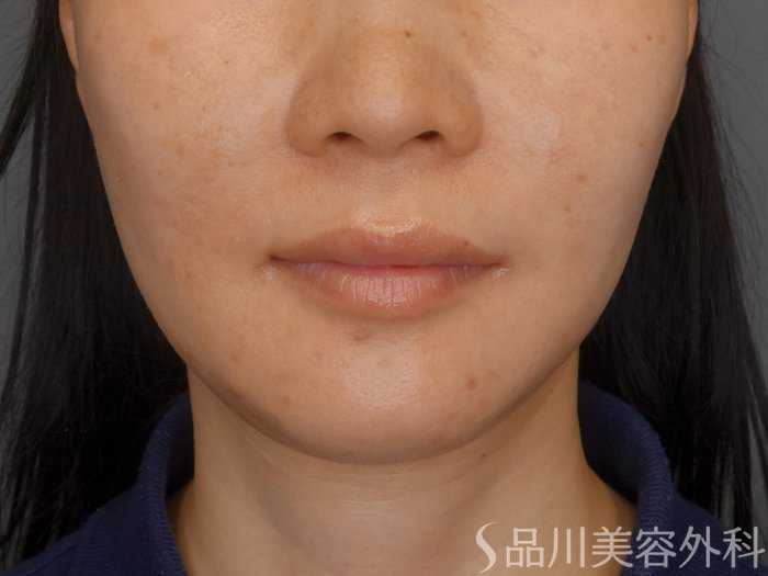 症例NO.70317のBEFORE写真
