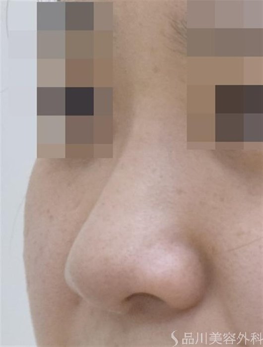 症例NO.50692のBEFORE写真