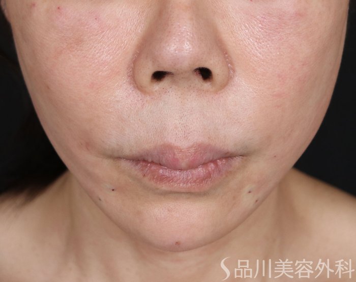 症例NO.70907のAFTER写真