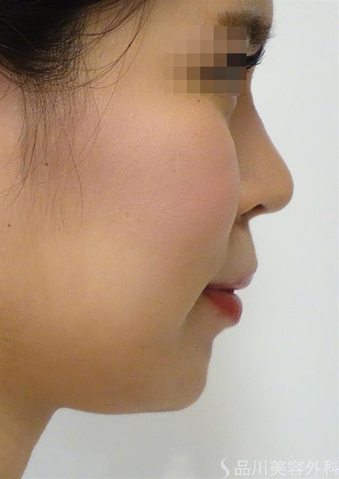症例NO.36421のAFTER写真