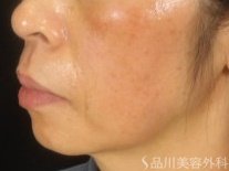 症例NO.72732のBEFORE写真