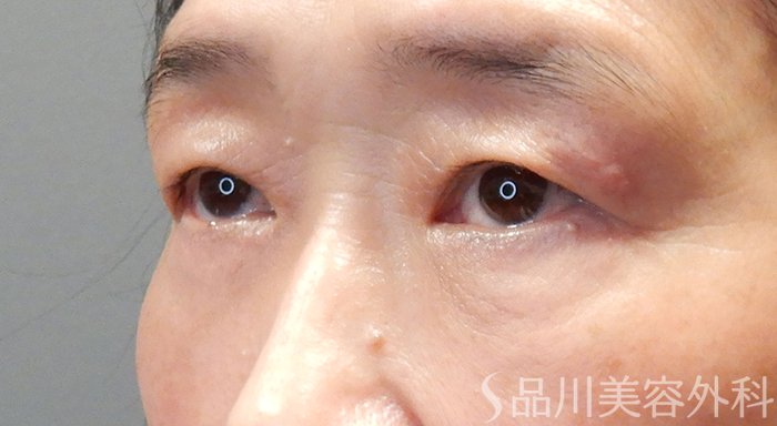 症例NO.70528のAFTER写真