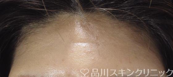 症例NO.43015のAFTER写真