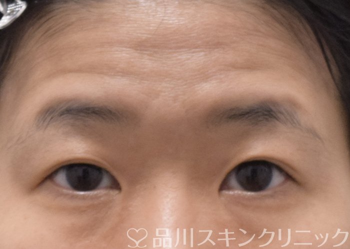 症例NO.73103のBEFORE写真