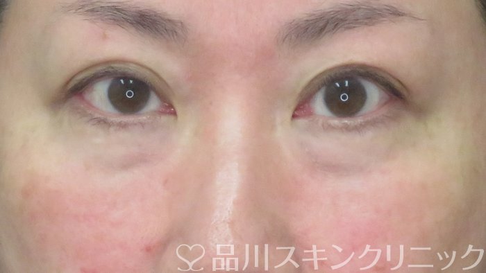 症例NO.72441のBEFORE写真