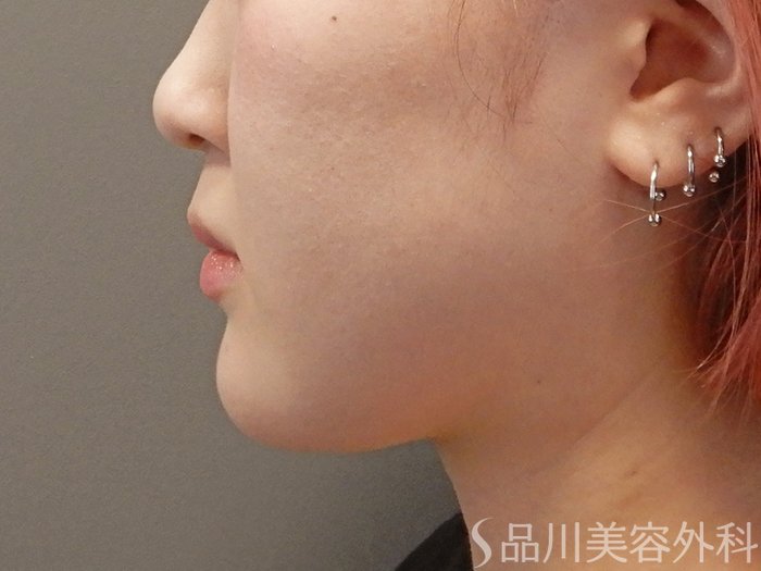 症例NO.71601のAFTER写真