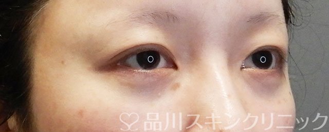 症例NO.74999のBEFORE写真