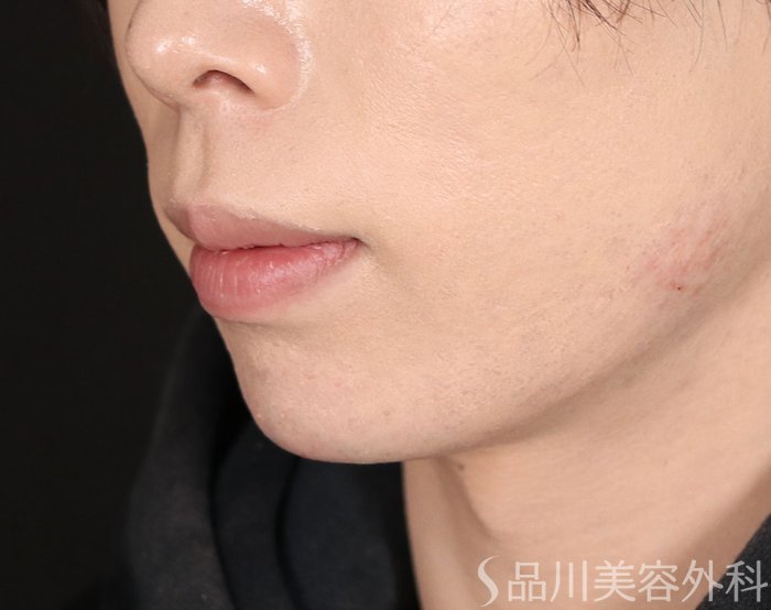 症例NO.72410のAFTER写真