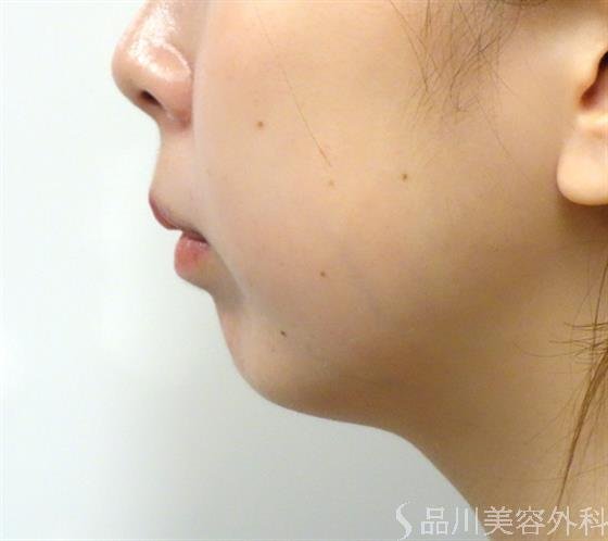 症例NO.35050のBEFORE写真