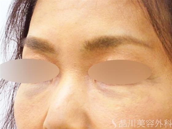 症例NO.51420のAFTER写真