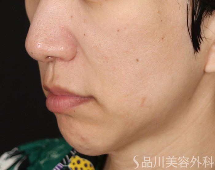 症例NO.71724のBEFORE写真