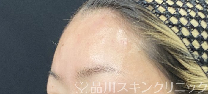 症例NO.73771のAFTER写真