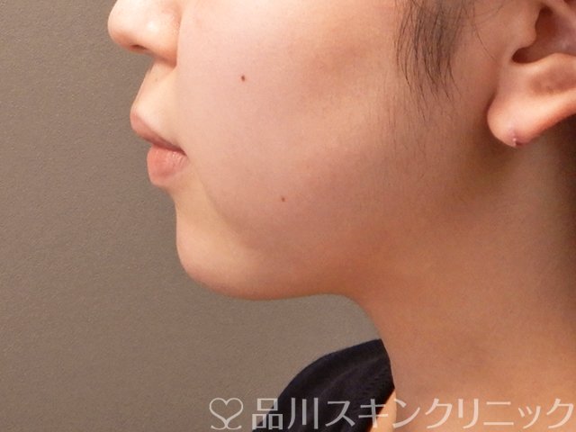症例NO.70992のAFTER写真
